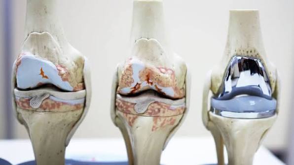 Conquering Pain: What You Need to Know About Total Knee Arthroplasty